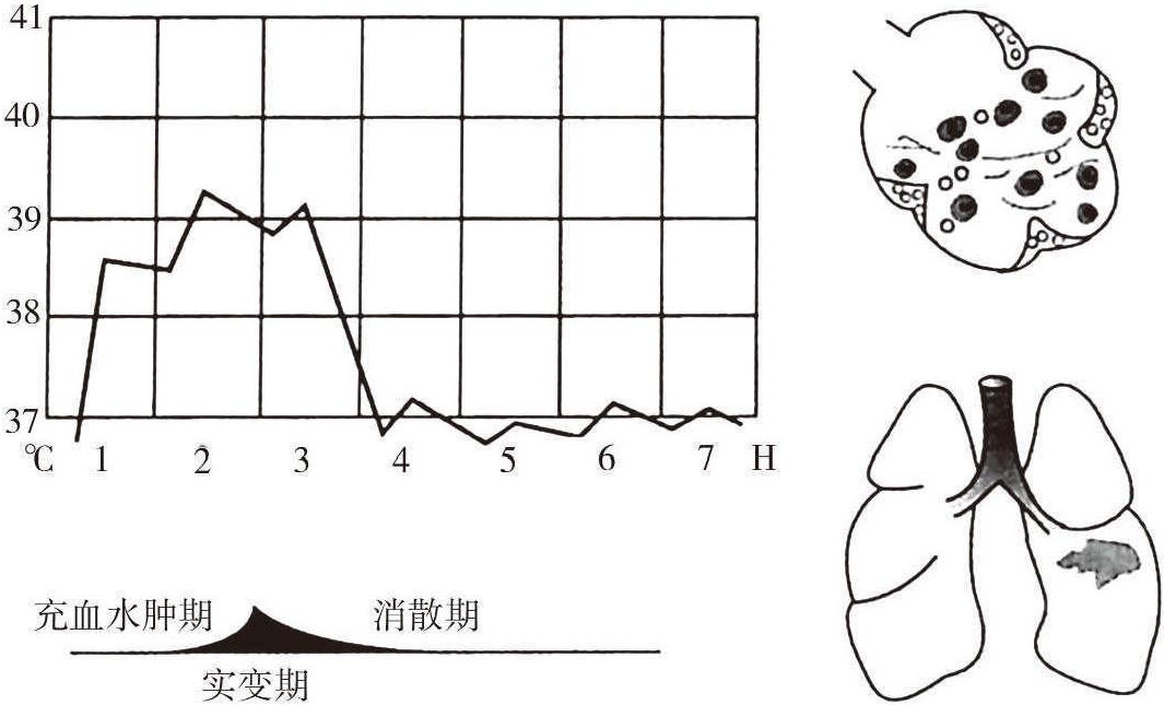 (一)大葉性肺炎
